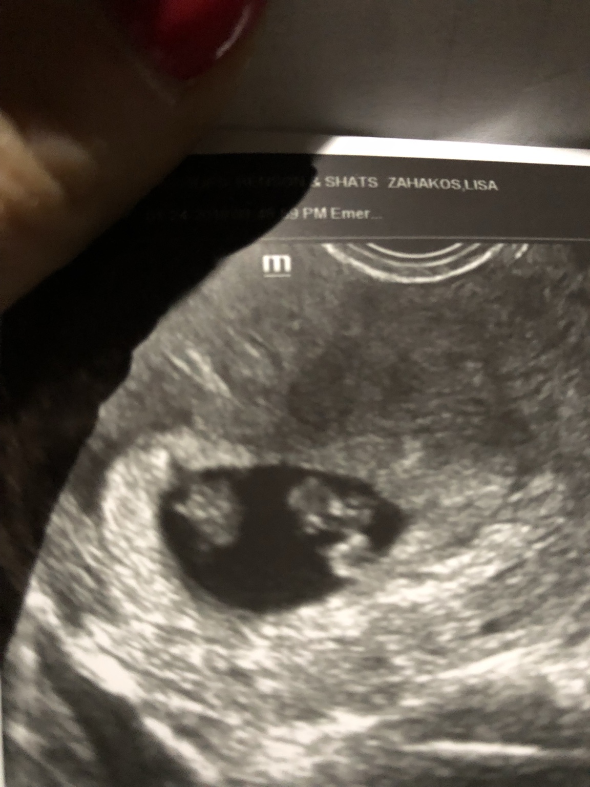 An original ultrasound photograph from Lisa’s pregnancy