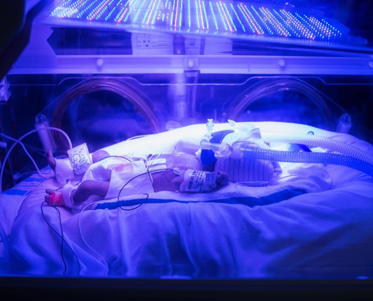 One of Lisa’s premature twins receiving care under blue lights in the NICU